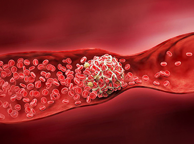 Thrombus als Abbildung für CME-Modul zu S3 Leitlinie Thromboseprophylaxe
