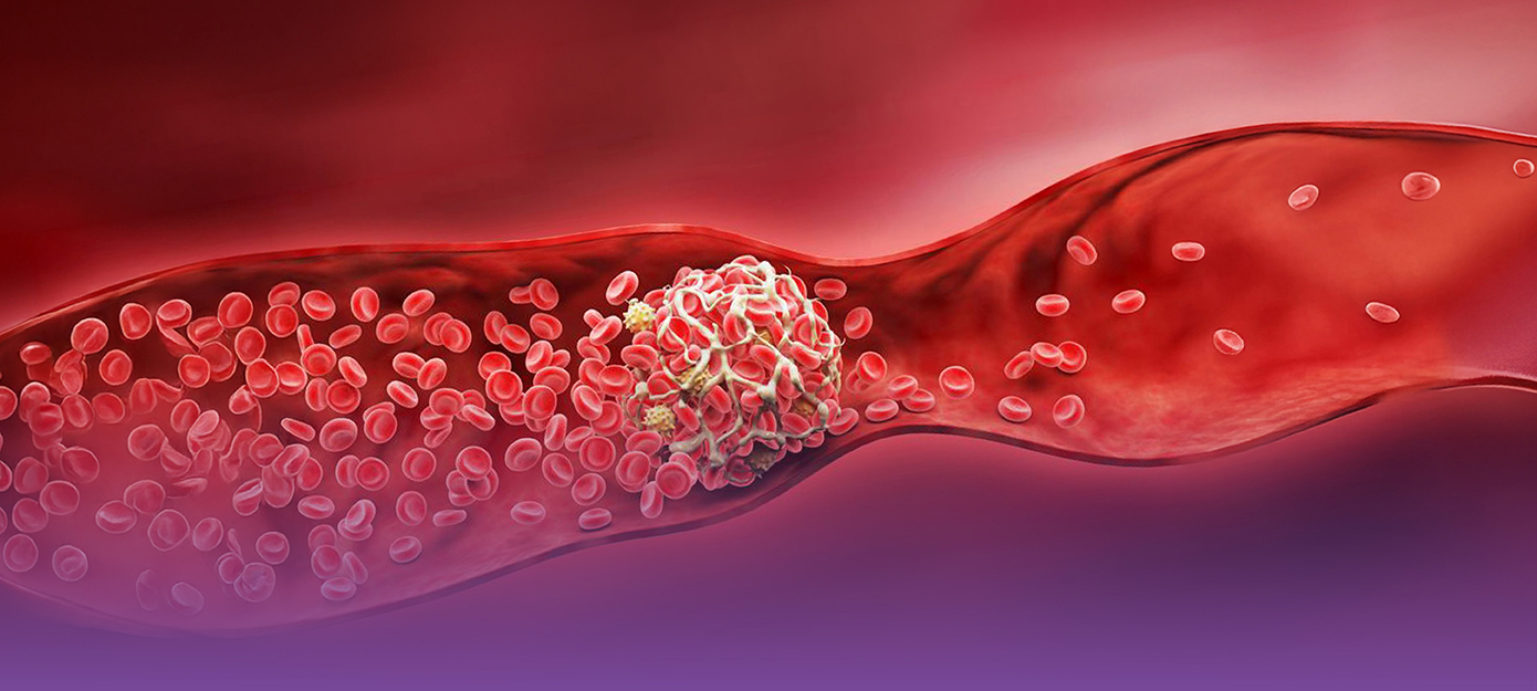 Thrombus als Abbildung für CME-Modul zu S3 Leitlinie Thromboseprophylaxe