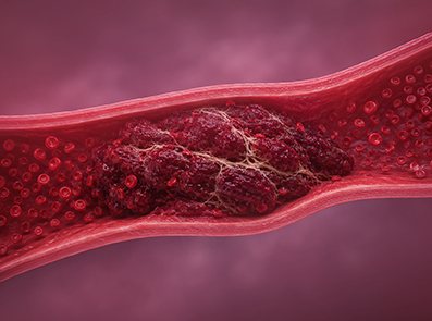 Thrombus als Abbildung für eCME-Highlights zur VTE-Prophylaxe und OVT-Therapie