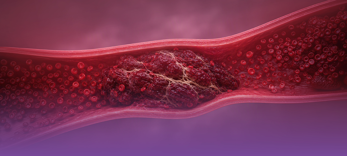 Thrombus als Abbildung für eCME-Highlights zur VTE-Prophylaxe und OVT-Therapie