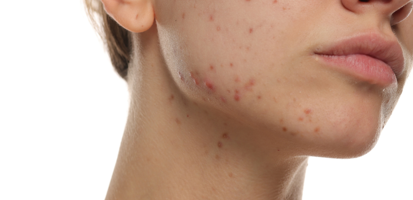 Klinische Darstellung entzündlicher Akne Vulgaris Läsionen im Bereich von Wange und Kiefer zur Illustration der Diagnose.