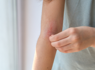 Rötlich entzündeter Ekzembereich am Unterarm mit typischem Juckreiz bei atopischer Dermatitis, dargestellt zur klinischen Einordnung
