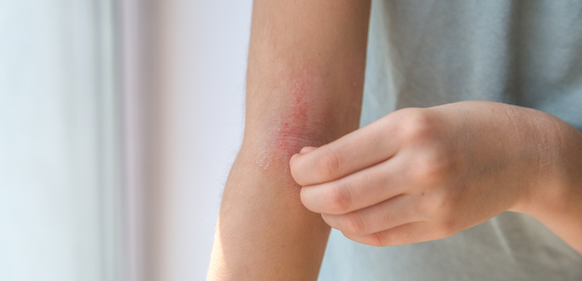 Rötlich entzündeter Ekzembereich am Unterarm mit typischem Juckreiz bei atopischer Dermatitis, dargestellt zur klinischen Einordnung