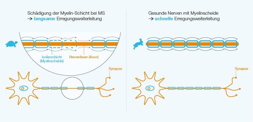 Vergleich einer geschädigten Myelin-Schicht einer Nervenzelle und einer gesunden Myelinscheide.