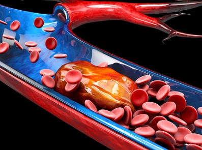 Thrombusbildung in der Vene